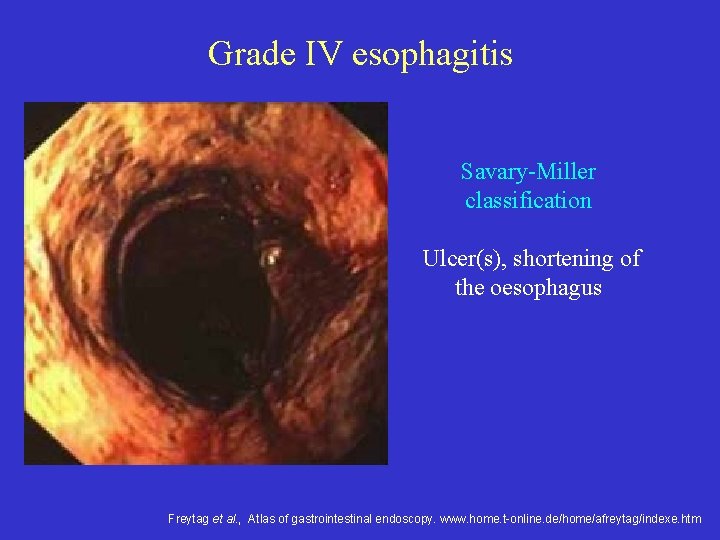 Grade IV esophagitis Savary-Miller classification Ulcer(s), shortening of the oesophagus Freytag et al. ,