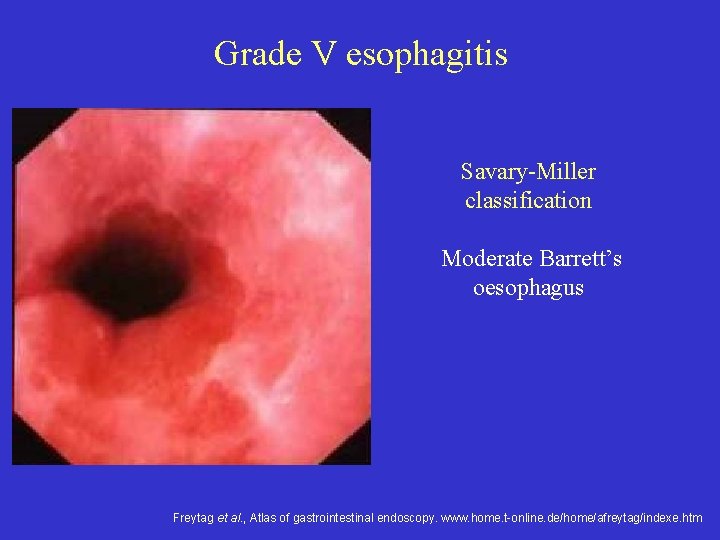 Grade V esophagitis Savary-Miller classification Moderate Barrett’s oesophagus Freytag et al. , Atlas of