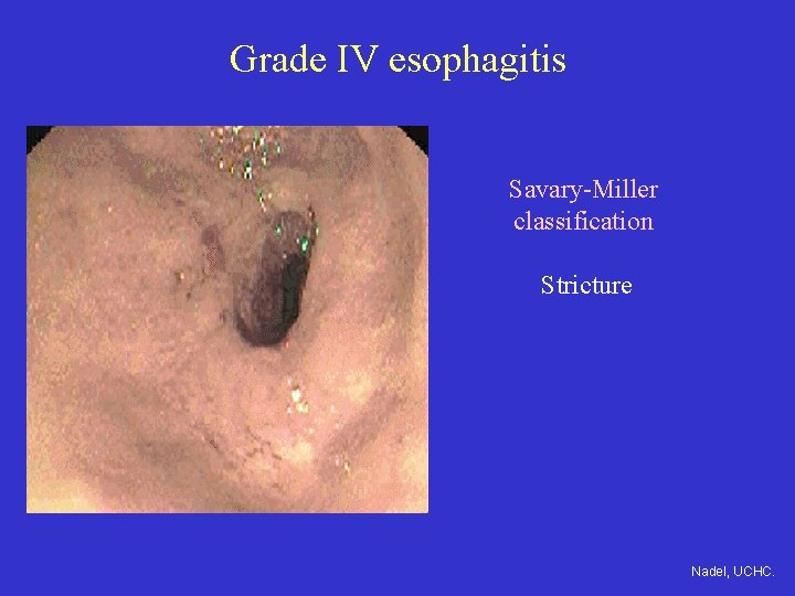 Grade IV esophagitis Savary-Miller classification Stricture Nadel, UCHC. 