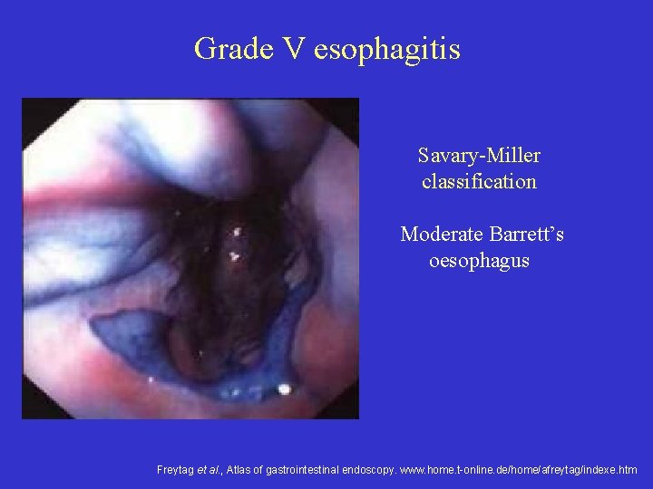 Grade V esophagitis Savary-Miller classification Moderate Barrett’s oesophagus Freytag et al. , Atlas of