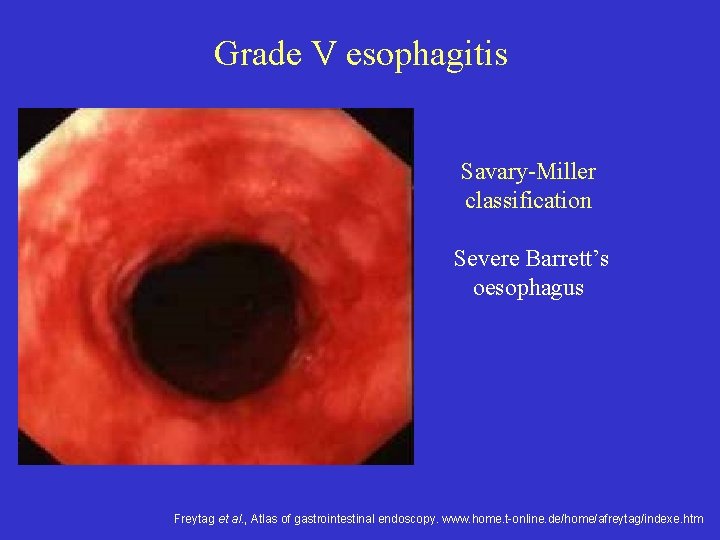 Grade V esophagitis Savary-Miller classification Severe Barrett’s oesophagus Freytag et al. , Atlas of