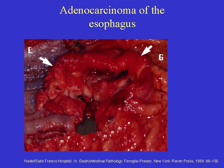 Adenocarcinoma of the esophagus Nadel/Saint Francis Hospital. In: Gastrointestinal Pathology. Fenoglio-Preiser, New York: Raven