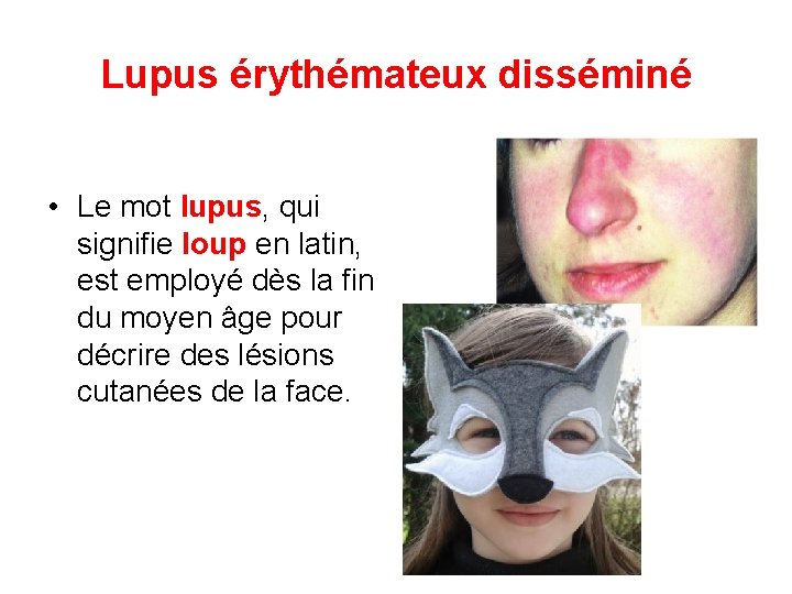 Lupus érythémateux disséminé • Le mot lupus, qui signifie loup en latin, est employé