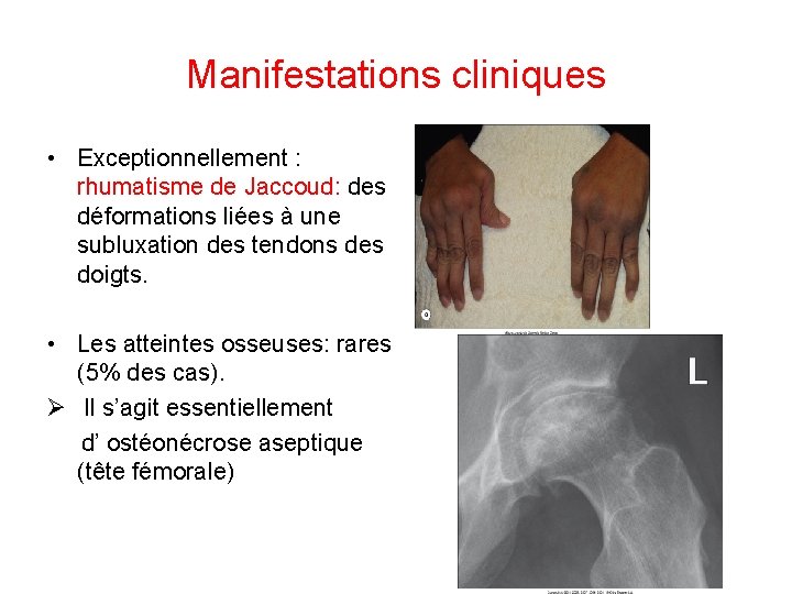 Manifestations cliniques • Exceptionnellement : rhumatisme de Jaccoud: des déformations liées à une subluxation