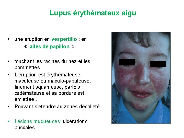 Lupus érythémateux aigu • une éruption en vespertilio : en ≪ ailes de papillon
