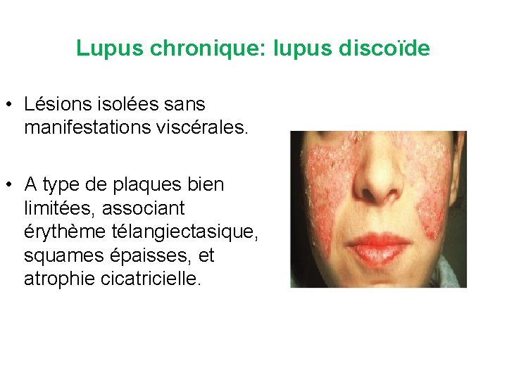 Lupus chronique: lupus discoïde • Lésions isolées sans manifestations viscérales. • A type de