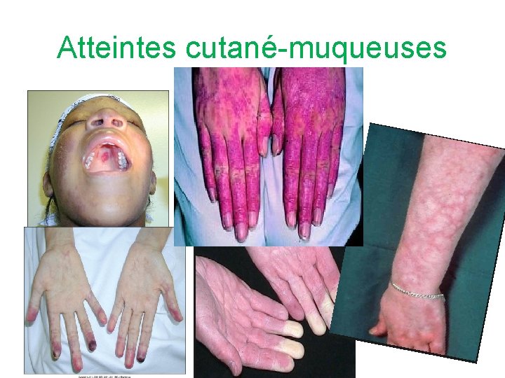 Atteintes cutané-muqueuses 