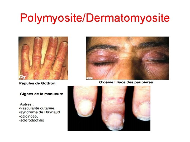 Polymyosite/Dermatomyosite 