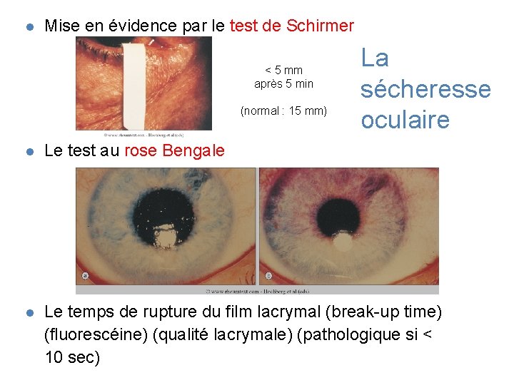 l Mise en évidence par le test de Schirmer < 5 mm après 5