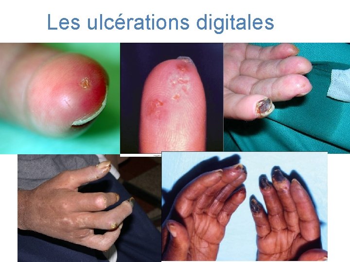 Les ulcérations digitales 