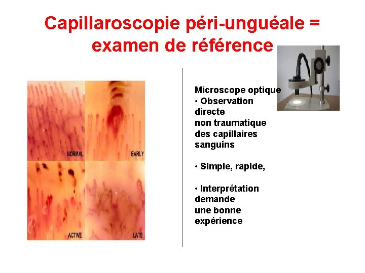 Capillaroscopie péri-unguéale = examen de référence Microscope optique • Observation directe non traumatique des