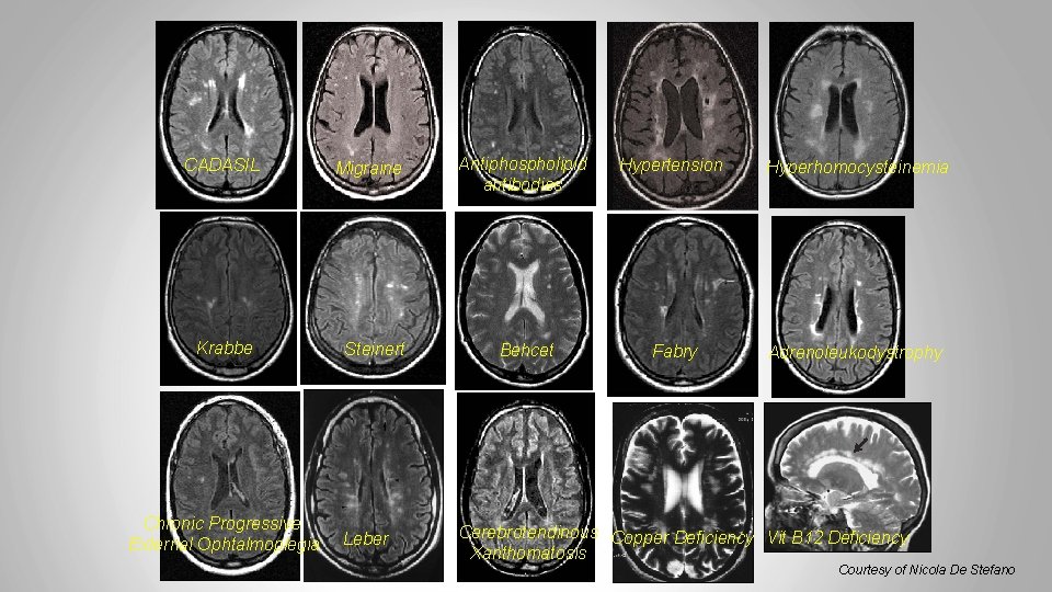 CADASIL Krabbe Chronic Progressive External Ophtalmoplegia Migraine Steinert Leber Antiphospholipid antibodies Hypertension Hyperhomocysteinemia Behcet