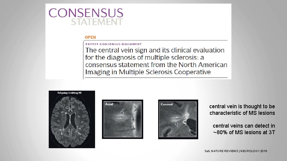 central vein is thought to be characteristic of MS lesions central veins can detect