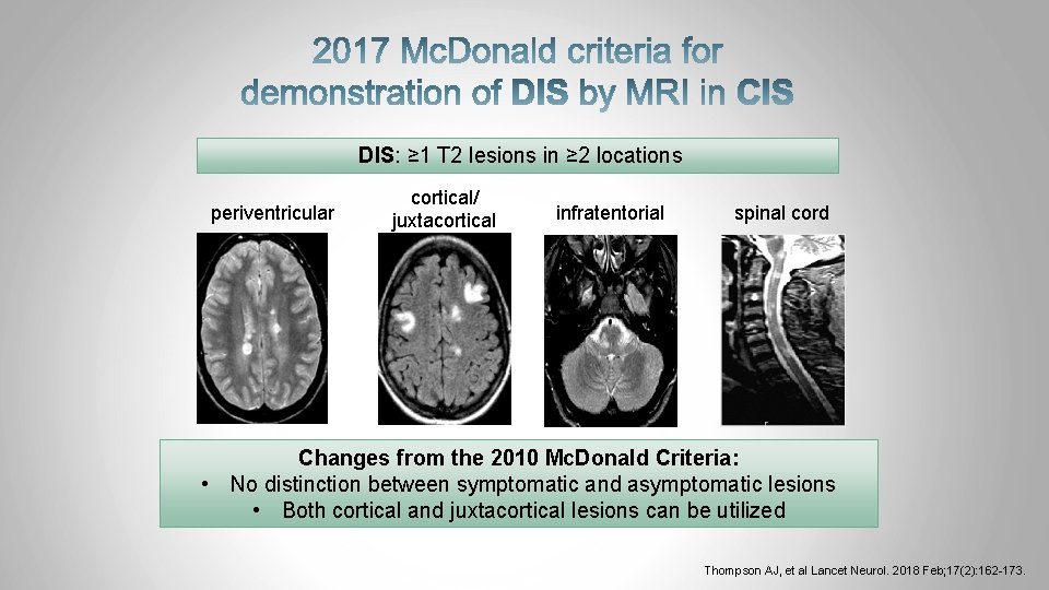 DIS: ≥ 1 T 2 lesions in ≥ 2 locations periventricular cortical/ juxtacortical infratentorial