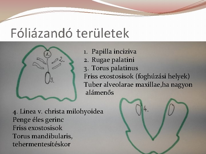 Fóliázandó területek 1. Papilla inciziva 2. Rugae palatini 3. Torus palatinus Friss exostosisok (foghúzási