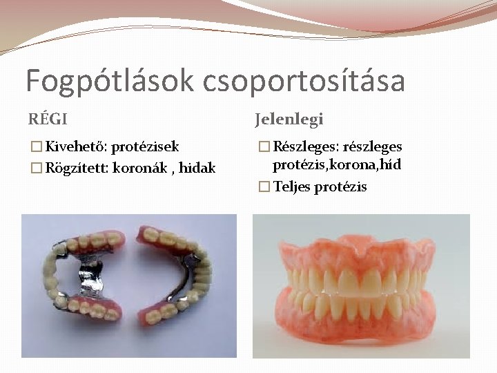 Fogpótlások csoportosítása RÉGI Jelenlegi �Kivehető: protézisek �Rögzített: koronák , hidak �Részleges: részleges protézis, korona,