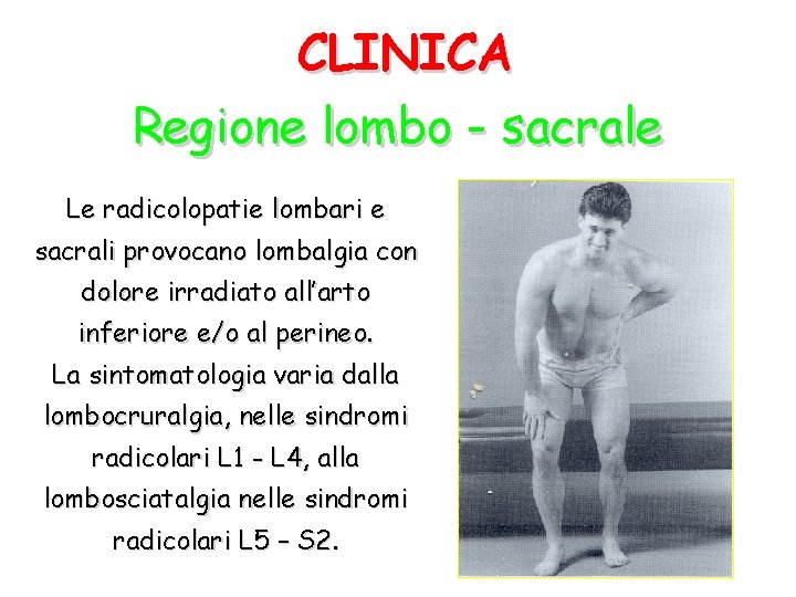CLINICA Regione lombo - sacrale Le radicolopatie lombari e sacrali provocano lombalgia con dolore