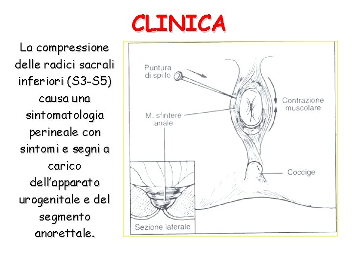 CLINICA La compressione delle radici sacrali inferiori (S 3 -S 5) causa una sintomatologia