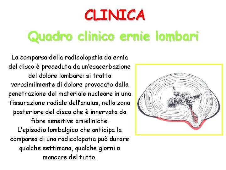 CLINICA Quadro clinico ernie lombari La comparsa della radicolopatia da ernia del disco è