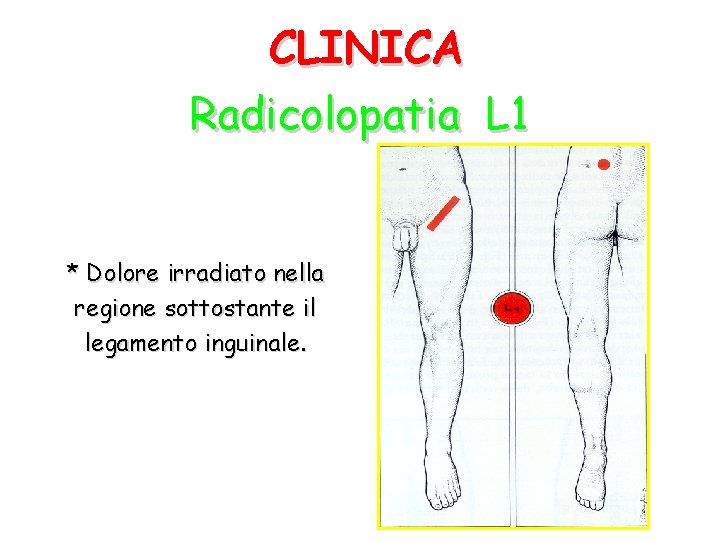 CLINICA Radicolopatia L 1 * Dolore irradiato nella regione sottostante il legamento inguinale. 