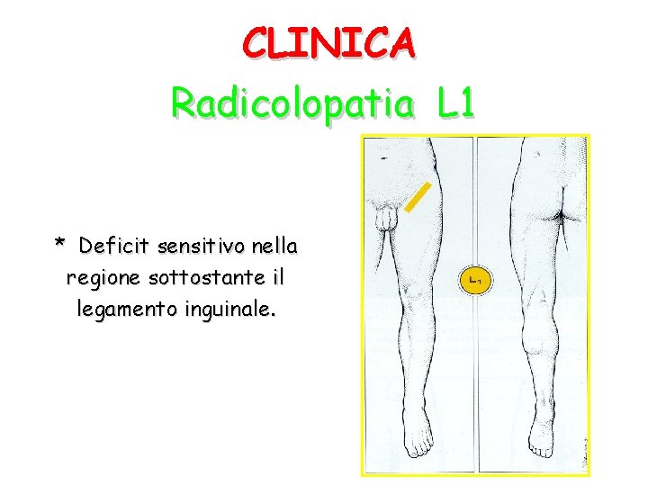 CLINICA Radicolopatia L 1 * Deficit sensitivo nella regione sottostante il legamento inguinale. 