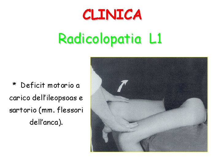 CLINICA Radicolopatia L 1 * Deficit motorio a carico dell’ileopsoas e sartorio (mm. flessori