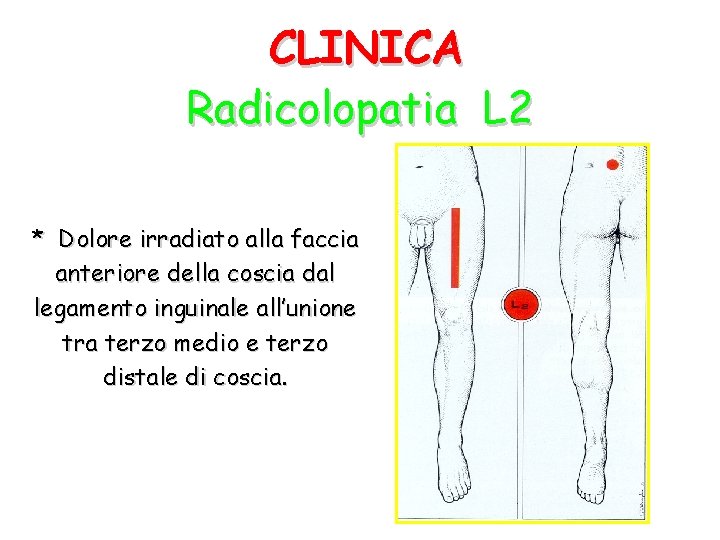 CLINICA Radicolopatia L 2 * Dolore irradiato alla faccia anteriore della coscia dal legamento
