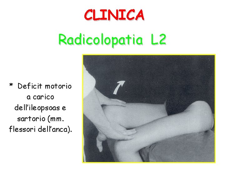 CLINICA Radicolopatia L 2 * Deficit motorio a carico dell’ileopsoas e sartorio (mm. flessori
