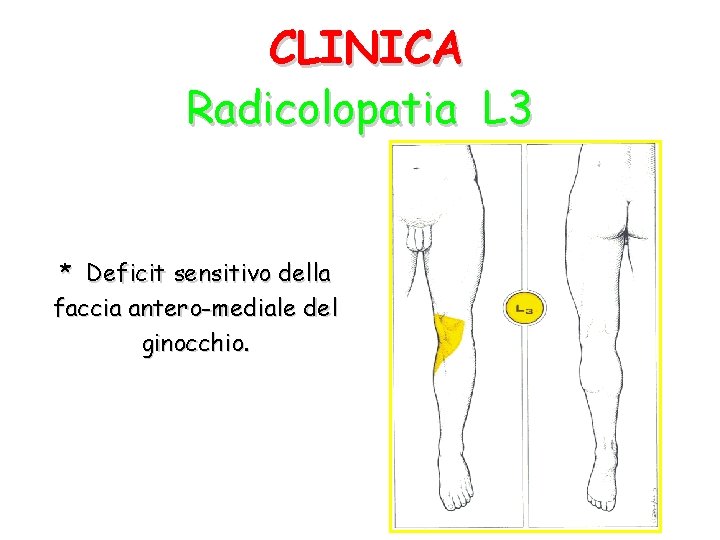 CLINICA Radicolopatia L 3 * Deficit sensitivo della faccia antero-mediale del ginocchio. 