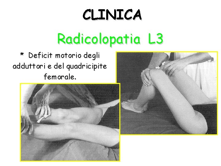 CLINICA Radicolopatia L 3 * Deficit motorio degli adduttori e del quadricipite femorale. 