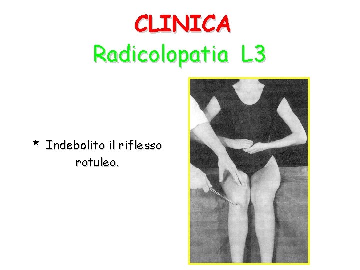 CLINICA Radicolopatia L 3 * Indebolito il riflesso rotuleo. 