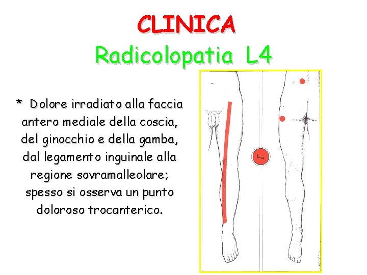 CLINICA Radicolopatia L 4 * Dolore irradiato alla faccia antero mediale della coscia, del