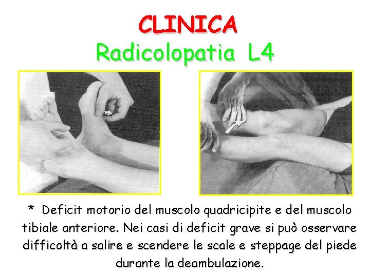 CLINICA Radicolopatia L 4 * Deficit motorio del muscolo quadricipite e del muscolo tibiale