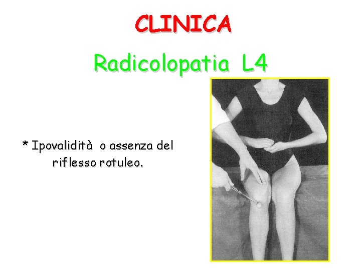 CLINICA Radicolopatia L 4 * Ipovalidità o assenza del riflesso rotuleo. 