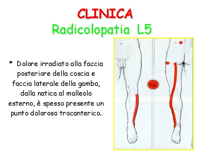 CLINICA Radicolopatia L 5 * Dolore irradiato alla faccia posteriore della coscia e faccia