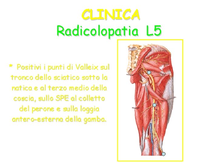 CLINICA Radicolopatia L 5 * Positivi i punti di Valleix sul tronco dello sciatico