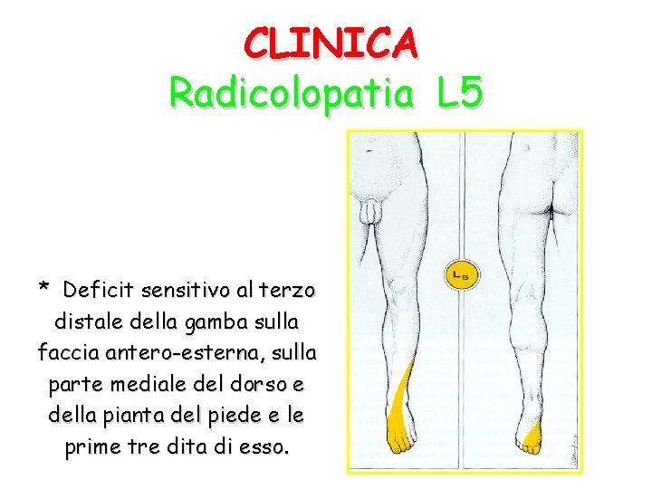 CLINICA Radicolopatia L 5 * Deficit sensitivo al terzo distale della gamba sulla faccia