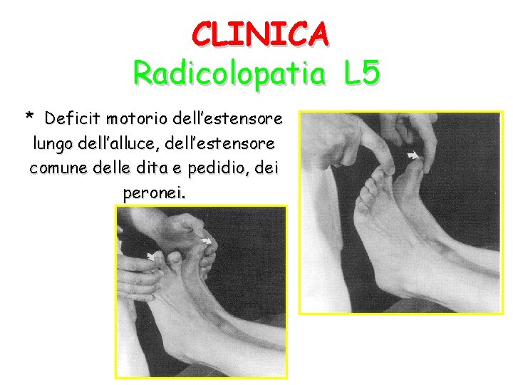 CLINICA Radicolopatia L 5 * Deficit motorio dell’estensore lungo dell’alluce, dell’estensore comune delle dita