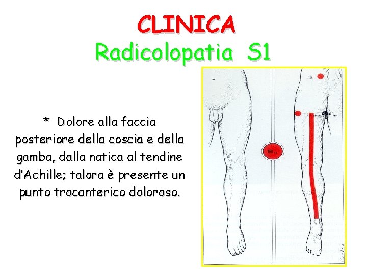 CLINICA Radicolopatia S 1 * Dolore alla faccia posteriore della coscia e della gamba,
