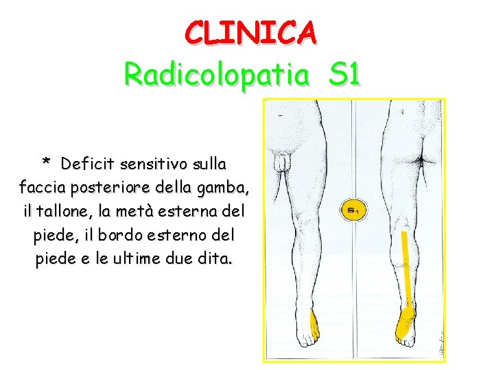 CLINICA Radicolopatia S 1 * Deficit sensitivo sulla faccia posteriore della gamba, il tallone,
