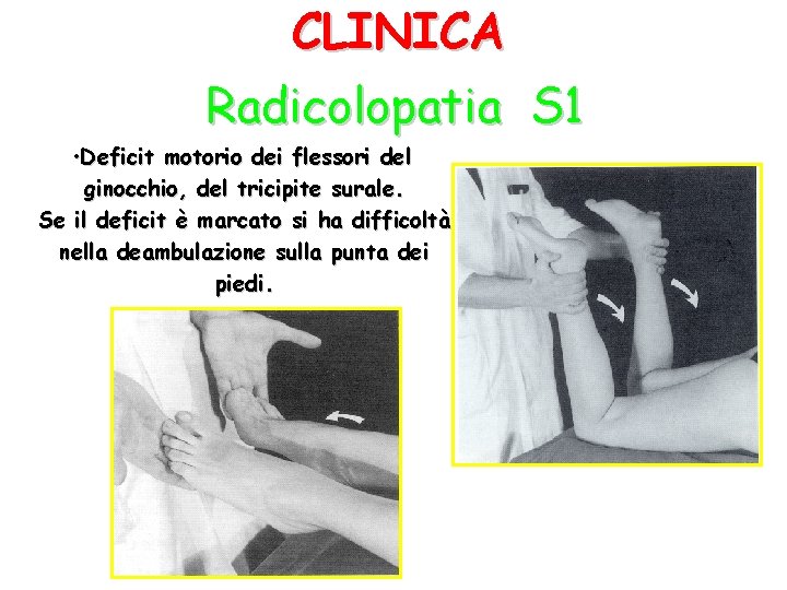 CLINICA Radicolopatia S 1 • Deficit motorio dei flessori del ginocchio, del tricipite surale.