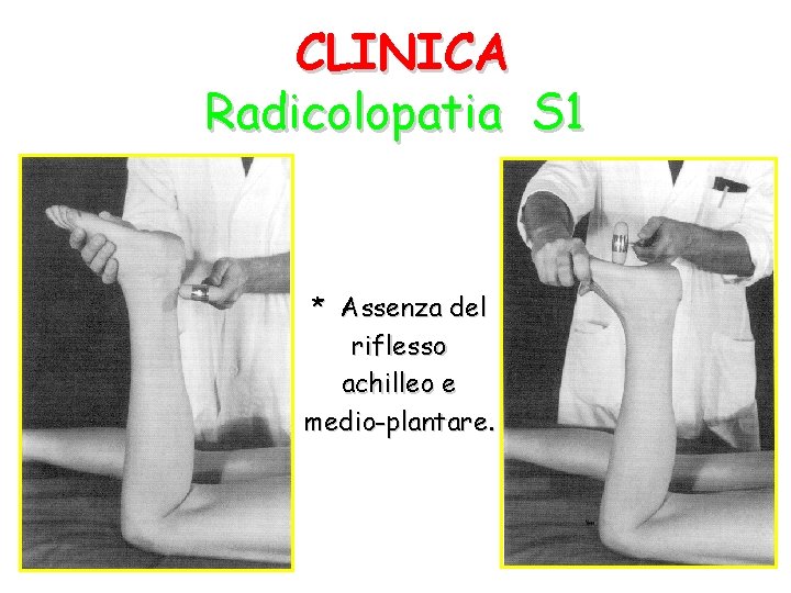 CLINICA Radicolopatia S 1 * Assenza del riflesso achilleo e medio-plantare. 