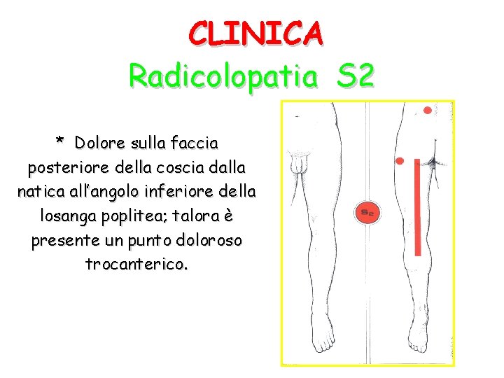 CLINICA Radicolopatia S 2 * Dolore sulla faccia posteriore della coscia dalla natica all’angolo