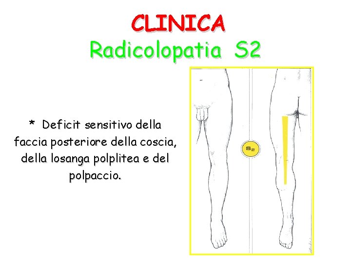 CLINICA Radicolopatia S 2 * Deficit sensitivo della faccia posteriore della coscia, della losanga