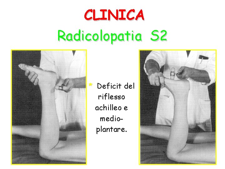 CLINICA Radicolopatia S 2 * Deficit del riflesso achilleo e medioplantare. 