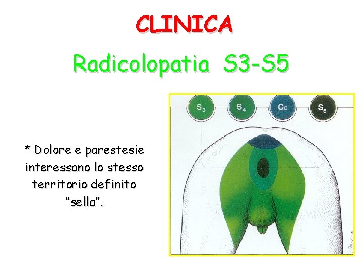 CLINICA Radicolopatia S 3 -S 5 * Dolore e parestesie interessano lo stesso territorio
