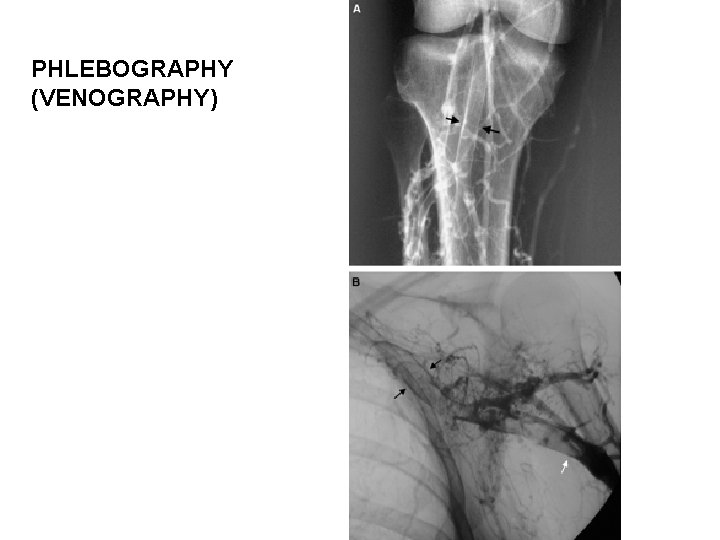 PHLEBOGRAPHY (VENOGRAPHY) 