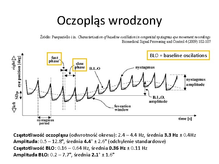Oczopląs wrodzony Źródło: Pasquariello i in. Characterisation of baseline oscillation in congenital nystagmus eye