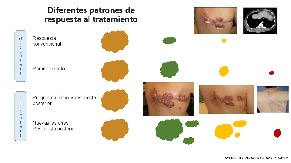 Diferentes patrones de respuesta al tratamiento +F R E C U E N T