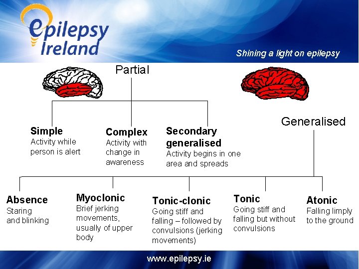 Shining a light on epilepsy Partial Simple Activity while person is alert Absence Staring